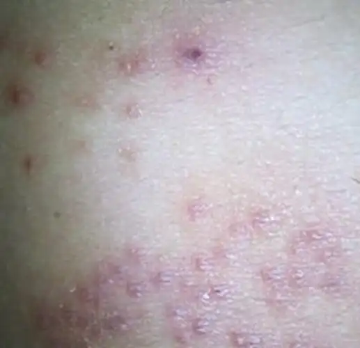 孕妇疥疮初期腹部皮肤症状图片