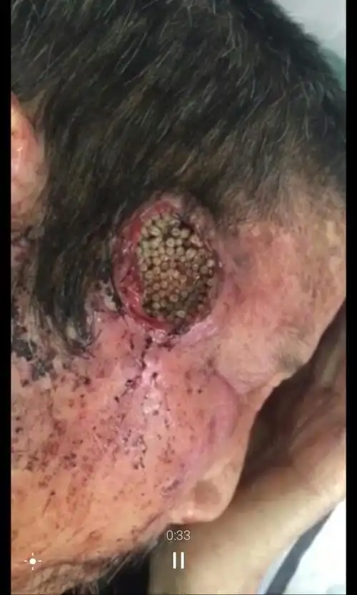 我看了一个视频,就是一个老人太阳穴里都是虫子,,,很恶心,请问,我们