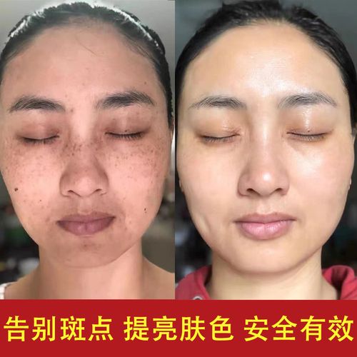 祛斑原液 去黄褐斑真皮斑美白祛斑液排色液377vc祛斑精华液提取液