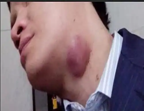 淋巴结肿大图片_淋巴结肿大症状表现图片大全_有来医生