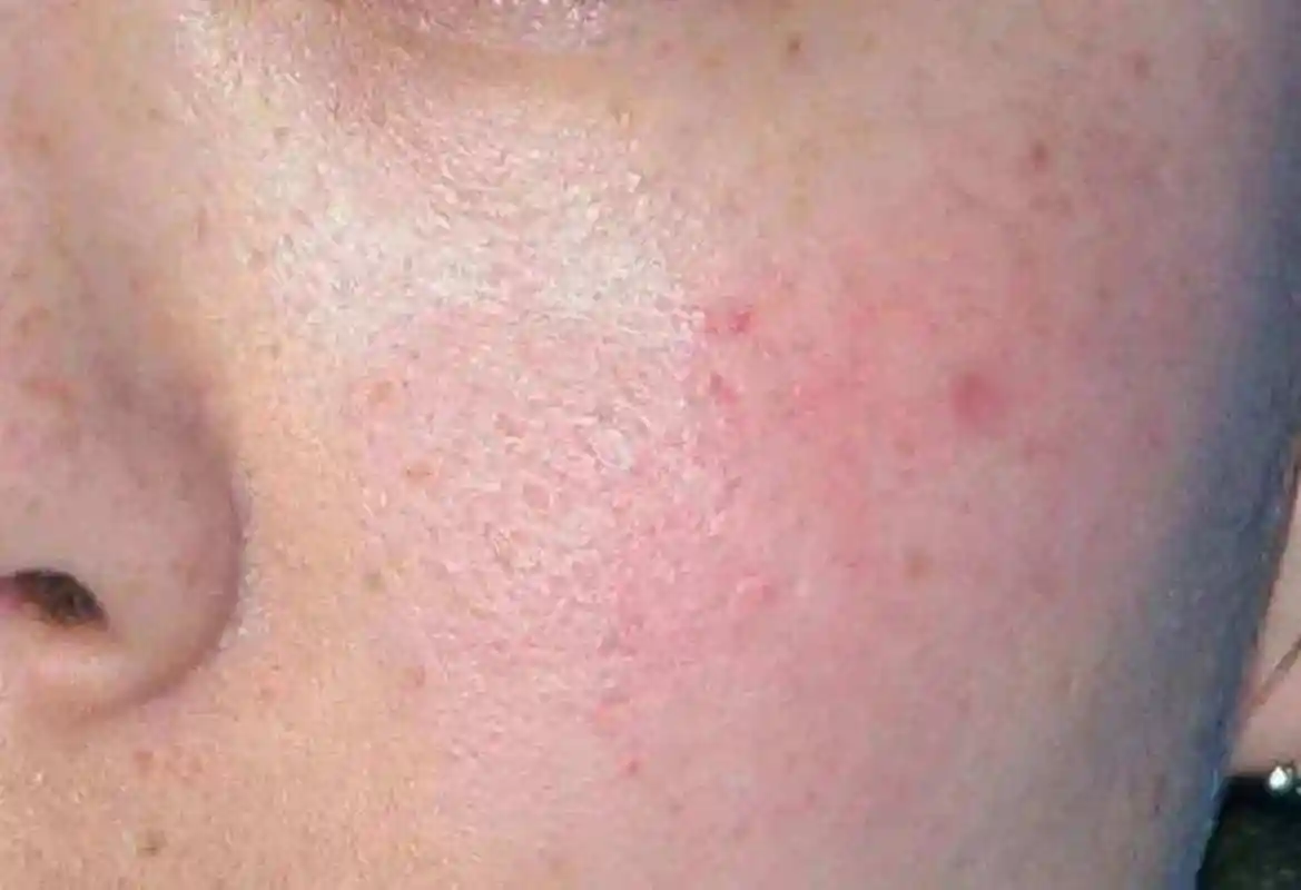 敷面膜脸上刺痛有灼烧感考虑可能是过敏,面部皮肤屏障功能受损,媚膜