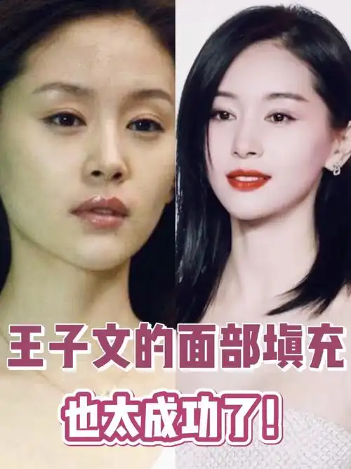 王子文的面部填充也太成功了吧
