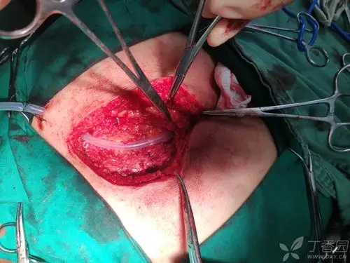 一例藏毛窦手术