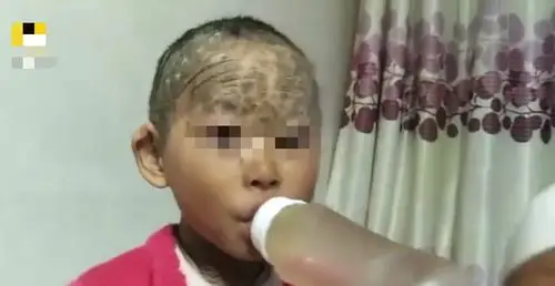 据孩子家人介绍,霞霞是生下来就得了鱼鳞病,三四天就会脱掉一层皮