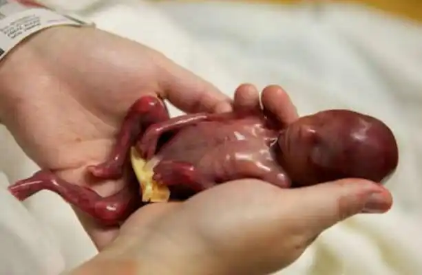 只有4个月的胎儿被迫生下,真让人心疼不已.