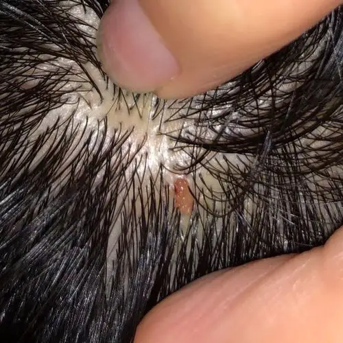 头皮长了个东西 请问这是什么 刚才以为是痘痘用手扣了 有点血