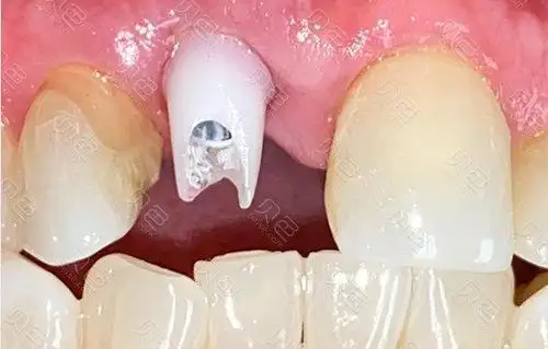 种植牙基台是什么材料?为什么有的是白色有的是金属色?
