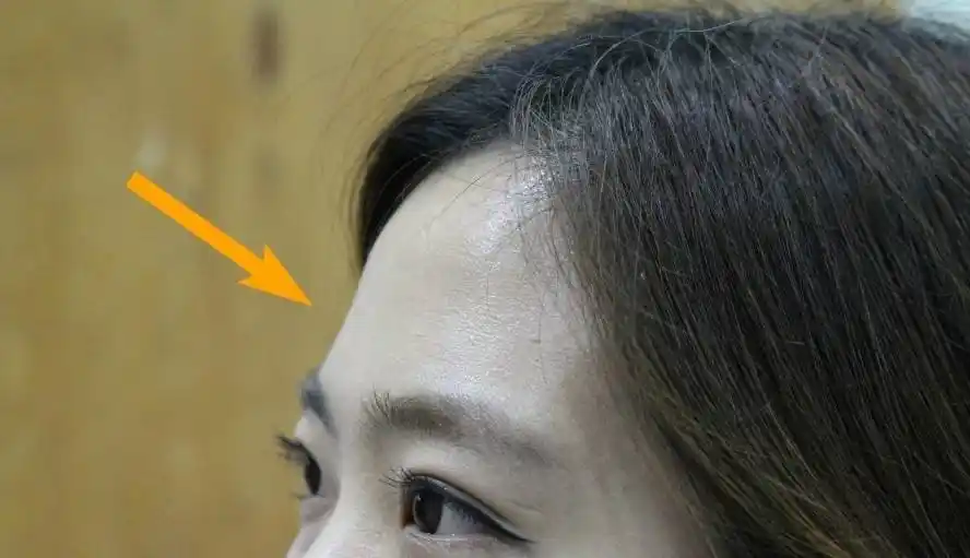 在微创美容中有一项丰额头的项目,就是让额头更加的好看.