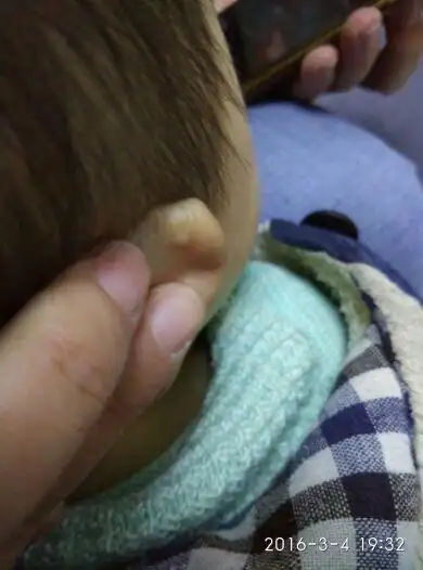 宝宝耳朵轮廓上有个小硬疙瘩