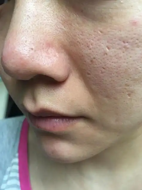 脸颊两边毛孔粗大怎么办 如何缓解面部毛孔粗大皮肤?