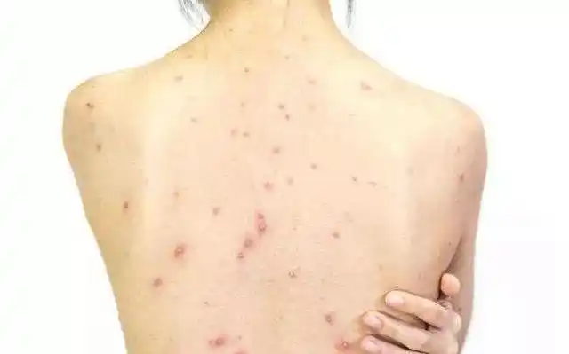 后背出油长痘,是为什么?教你3个方法还你光洁后背