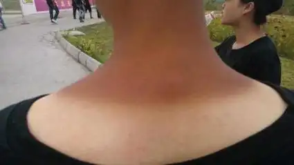 夏天晒黑的皮肤怎么白回来? 只需这样敷一敷, 让你迅速恢复白皙