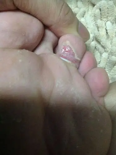 脚丫烂得不成样子了?怎么办?图片是刚才拍的.这个是什么症状?