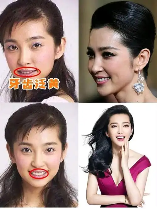 烤瓷牙翻车的明星合集