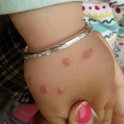 各位宝妈们,宝宝最近几天胳膊上出了好多这种水泡,昨天去医院医生说