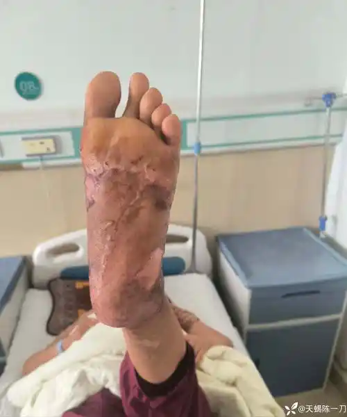 足的皮肤坏死--植皮-康复锻炼.