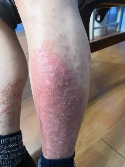 皮肤都是干燥脱屑银屑病和鱼鳞病有什么不同