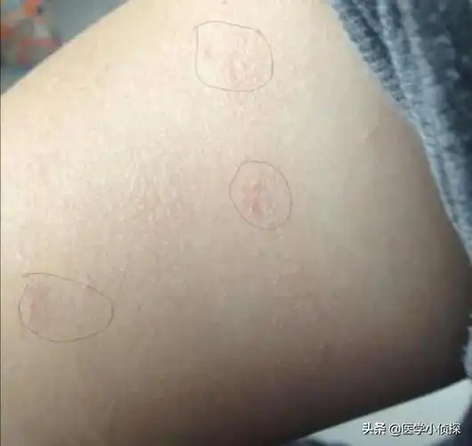 艾滋病病毒|皮肤病|皮疹_网易订阅