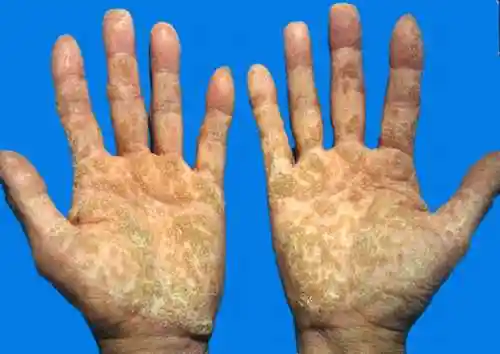 医学全在线 医学图谱 皮肤学 角化性皮肤病 > 正文:遗传掌跖角皮症