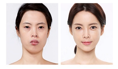 韩国jayjun脂肪填充前后对比照
