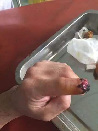 请问,我在上班的时候把左手食指断了一个骨节,大概能赔偿多少,食指没