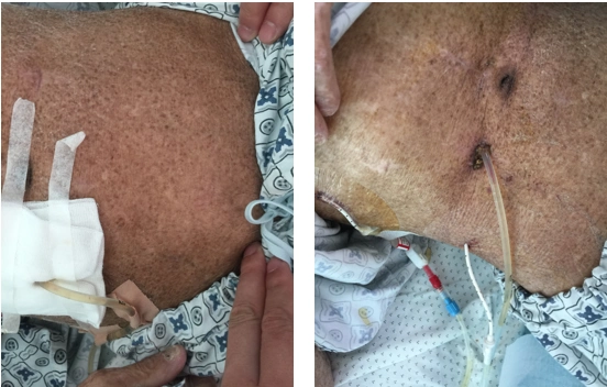 胃癌术后严重乳糜漏一例