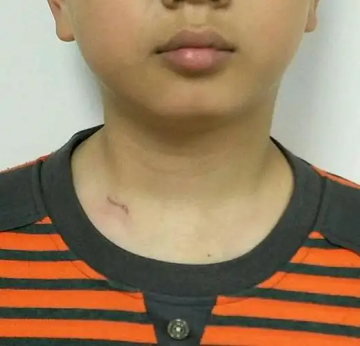 为什么我的孩子脖子是歪的?