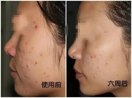 和其他海藻萃取精华混合形成的敷料,通过在皮肤上形成极其微小的出口