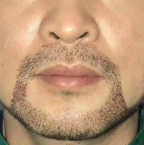 由于种种原因,有些男性的胡须不能满足自己的需求,这时候种植胡须就成