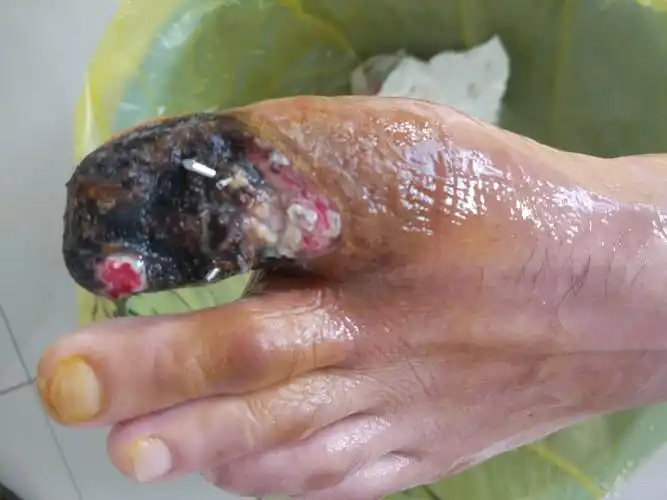 第一趵趾骨骨折术后2月余,在外面包药后出现皮肤坏死,骨外露,请求指导