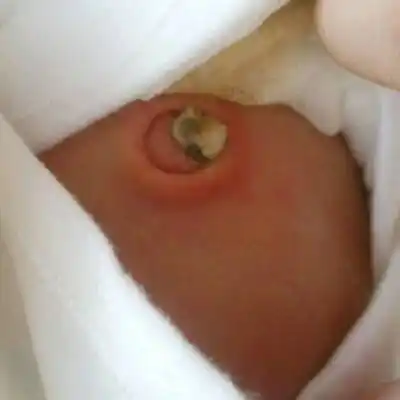 你们的宝宝肚脐有这样的吗?求解!