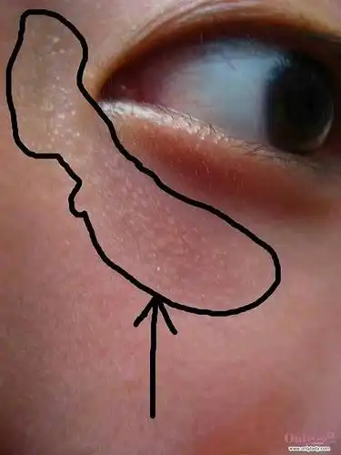 求助这是啥啊脂肪粒吗