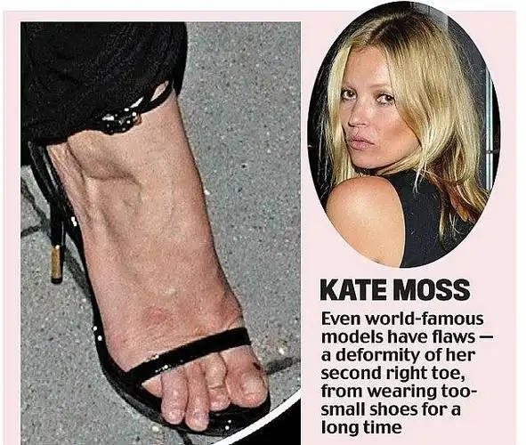 脚趾形变:因为工作原因,在众多场合下女明星都得穿着高跟鞋.