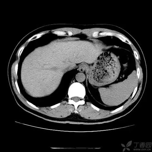 【讨论】肝内胆管轻度扩张,有哪些原因?