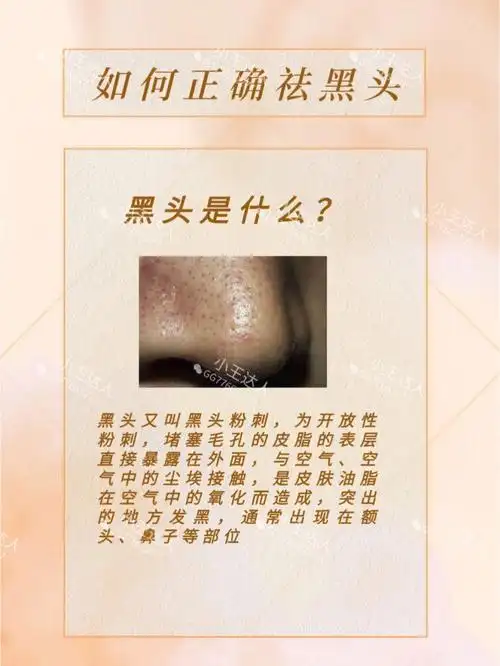 女生必看60如何正确去除黑头草莓鼻
