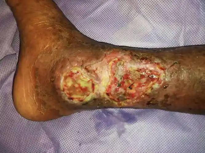 下肢皮肤坏死感染～慢创