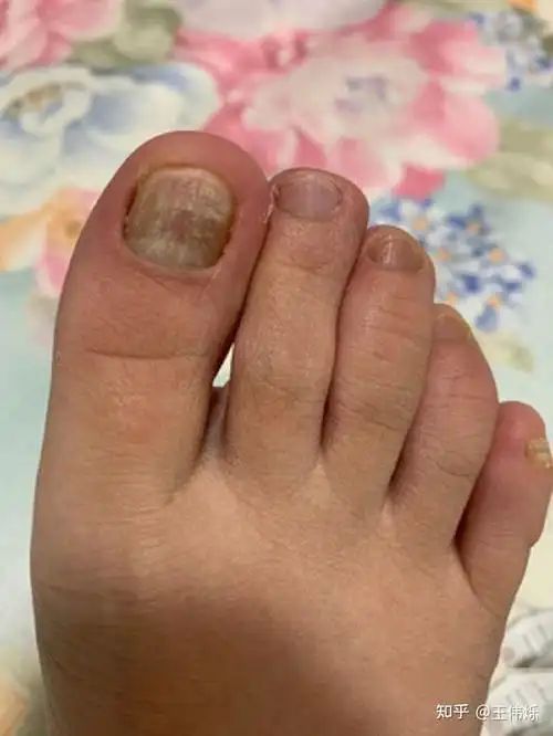 零风险!上海治疗灰指甲"红红火火"-第2张图片-若克网