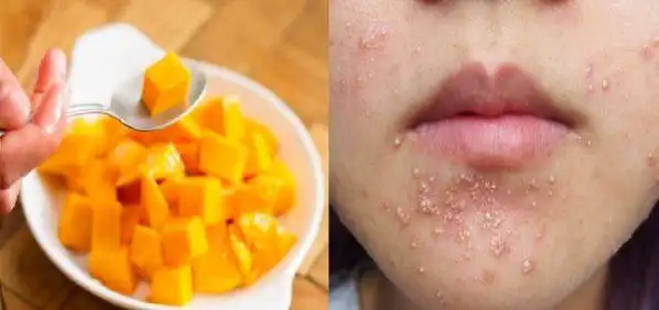 其实芒果属于"发物",而那些吃了芒果中毒的人都是因过敏而造成的!