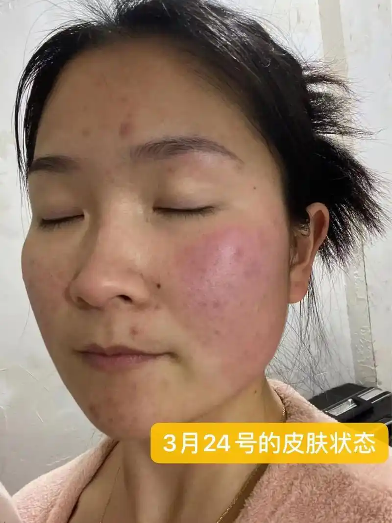 又帮助了一位明感机粉丝宝宝改善了皮肤困扰为你开心