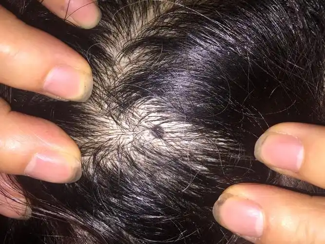 头顶上最近发现有一个黑色硬疙瘩