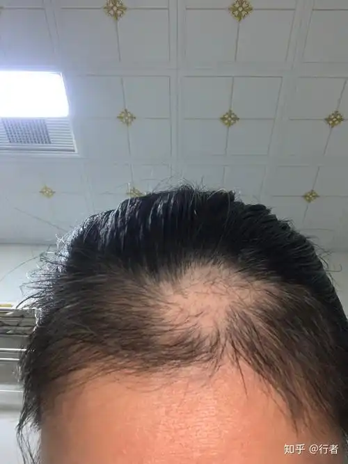 拔毛癖的自救之路