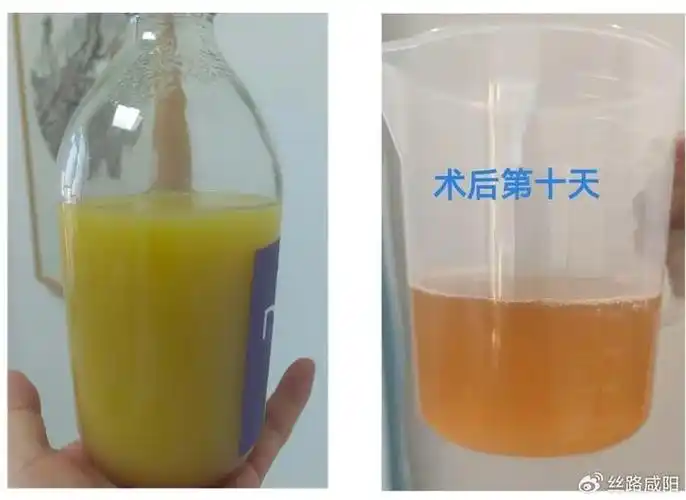 咸阳市中心医院新技术 1:乳糜漏怎么破?
