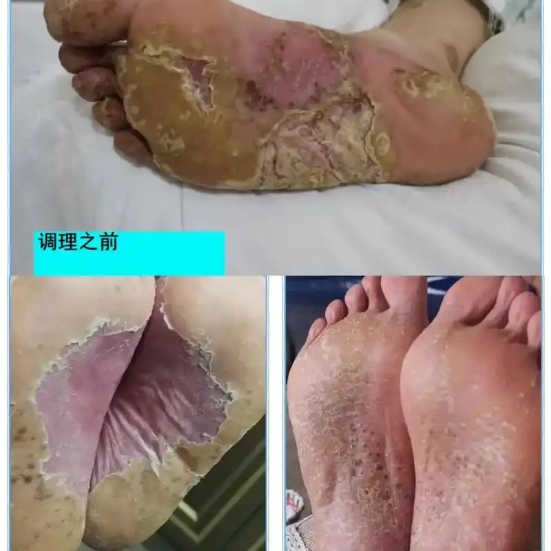 糖尿病从13.77降到5.85,以及皮肤的整体恢复,用时四个 - 抖音