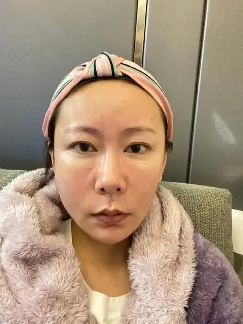 为止我已经做完艾丽薇玻尿酸填充泪沟20天了,现在处于效果稳定期了,特