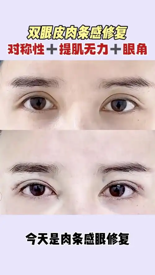 双眼皮肉条感修复,对成 提肌无力 眼角-度小视