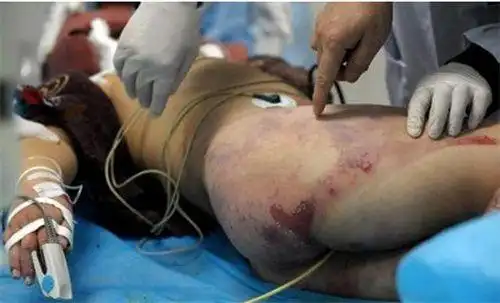 青海女子燕志云虐女,滚油灌嘴纱线缝口被判7年,出狱挖骨灰泄愤|苏丽