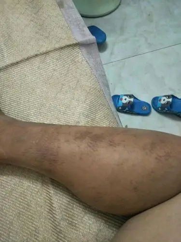 小腿长黑色斑点