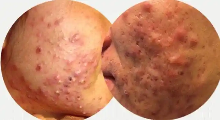 痤疮又名青春痘