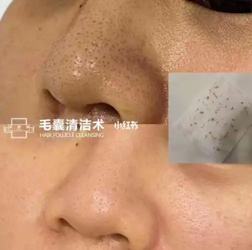 顾客毛囊清洁 对比图 一次让你看到效果 我们的毛囊清洁术的清洁不光