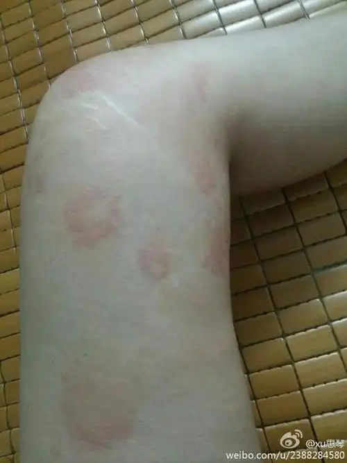 皮肤过敏,过敏[泪][泪]谁有办法?怎么样才能好起来,打针吃药?